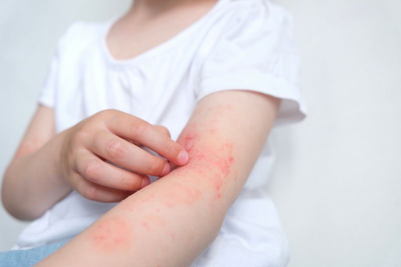 Santé des enfants : qu’est-ce que la dermatite atopique ?