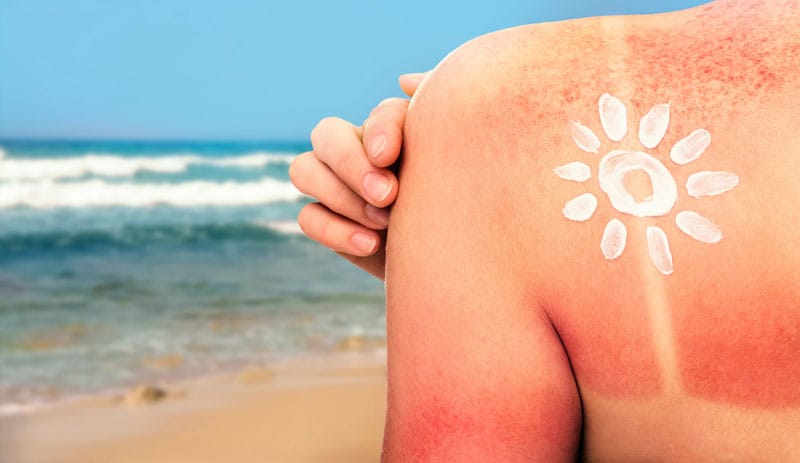 Coup de soleil : comment le prévenir ?